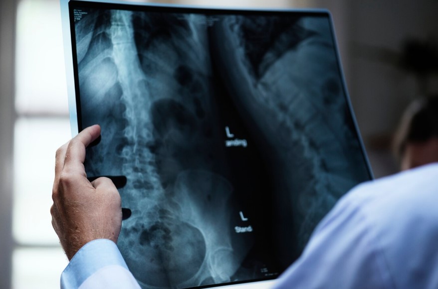 Spineax - Cirugía de escoliosis | Dr. Juan Carlos Pérez