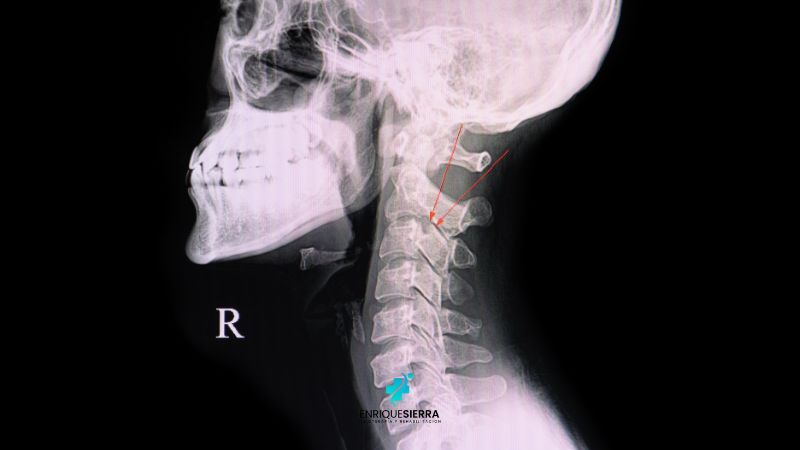 Hernia discal Cervical - Cirujano de Columna en Bogotá - Spine Ax