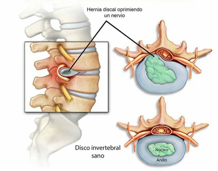 Hernia discal - Cirujano de Columna en Bogotá - Spine Ax