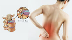 Hernia discal - Cirujano de Columna en Bogotá - Spine Ax