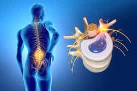 Hernia discal - Cirujano de Columna en Bogotá - Spine Ax