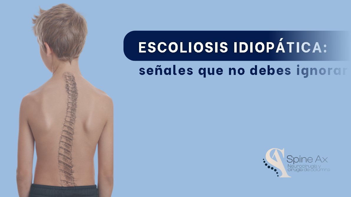 Escoliosis Idiopática- Especialistas en cirugía de columna-SpineAx