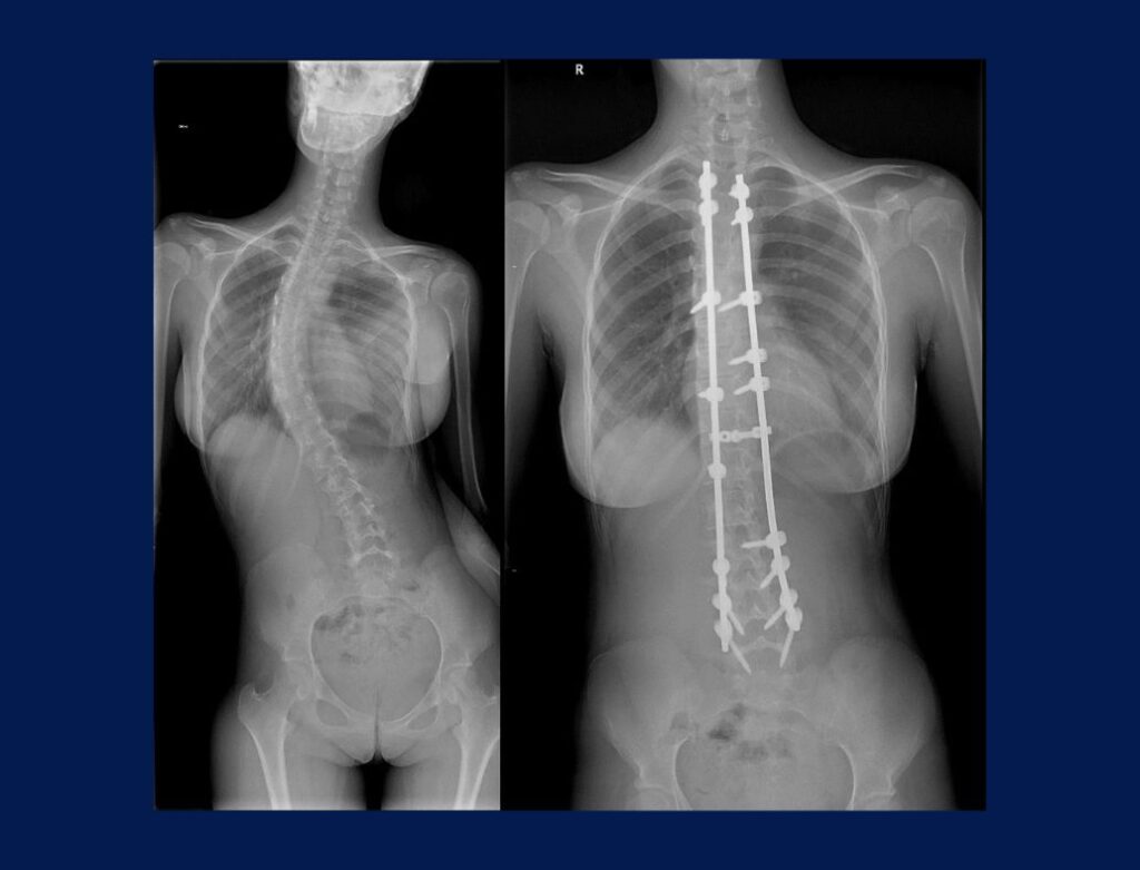Escoliosis idiopática - Dr. Juan Cárlos Pérez