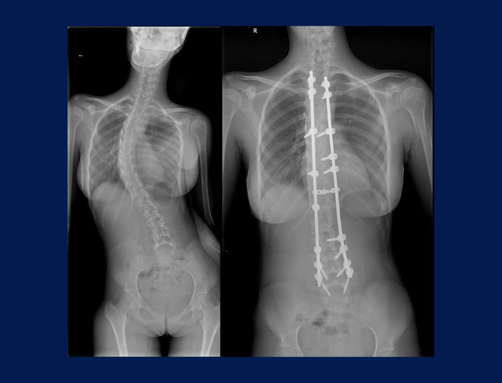 Escoliosis idiopática - Dr. Juan Cárlos Pérez