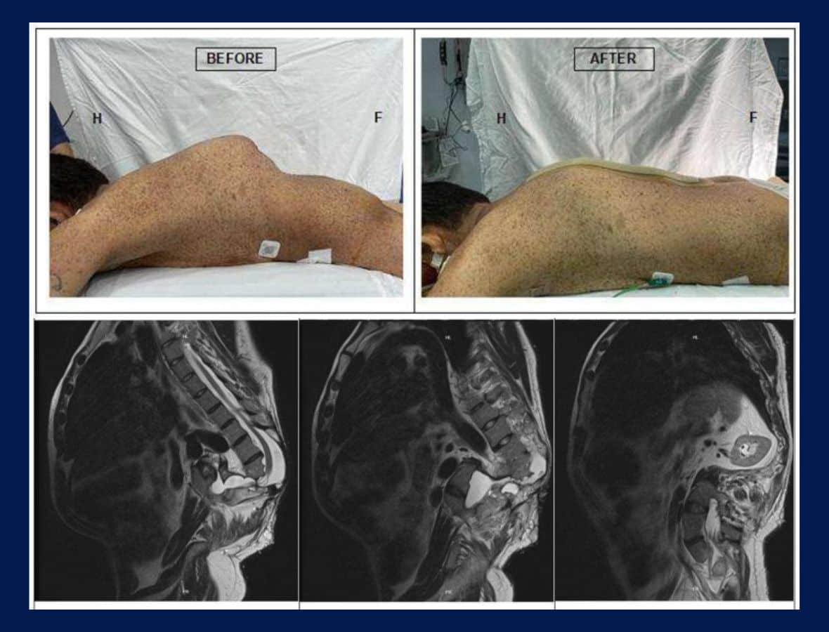 Manejo de una cifoescoliosis distrofia severa en una paciente con neurofibromatosis tipo 1
