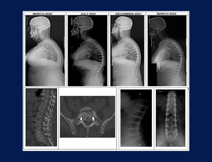 Pedicle Subtraction Osteotomy on a Patient with Severe Sagittal Imbalance Progression But Proportionate Gap Score Case Report and Lliterature Review
