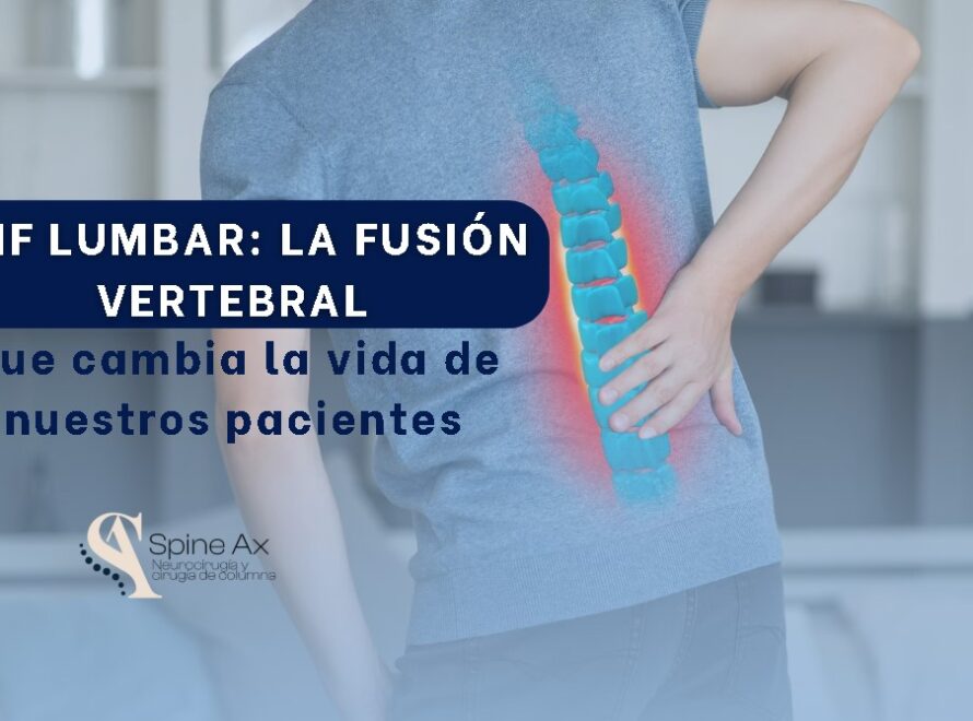 Tlif lumbar-SpineAX