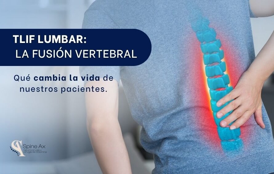 Tlif lumbar-SpineAX