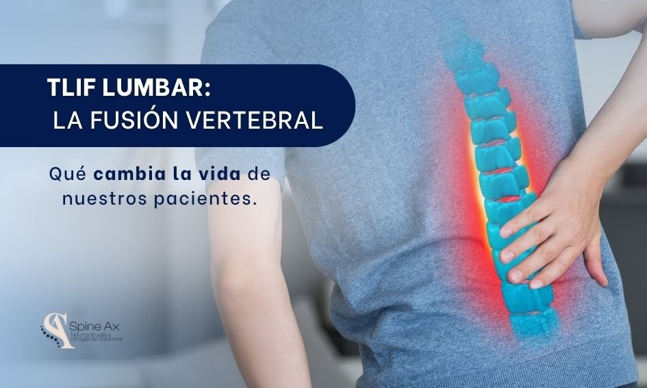 Tlif lumbar-SpineAX