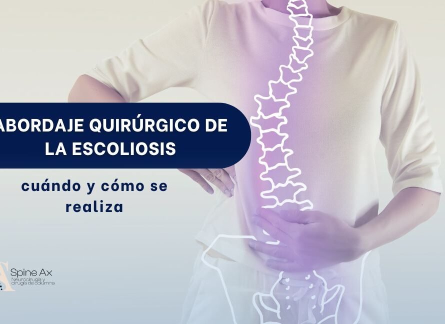 Cirugía de columna por escoliosis - Spine AX