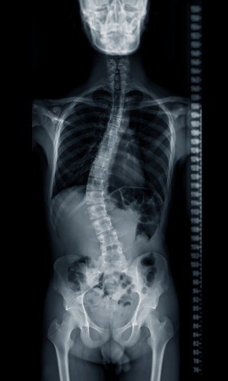 Radiografía de persona con escoliosis - Imagen de referencia - Cirugía de escoliosis en Bogotá - Spine AX