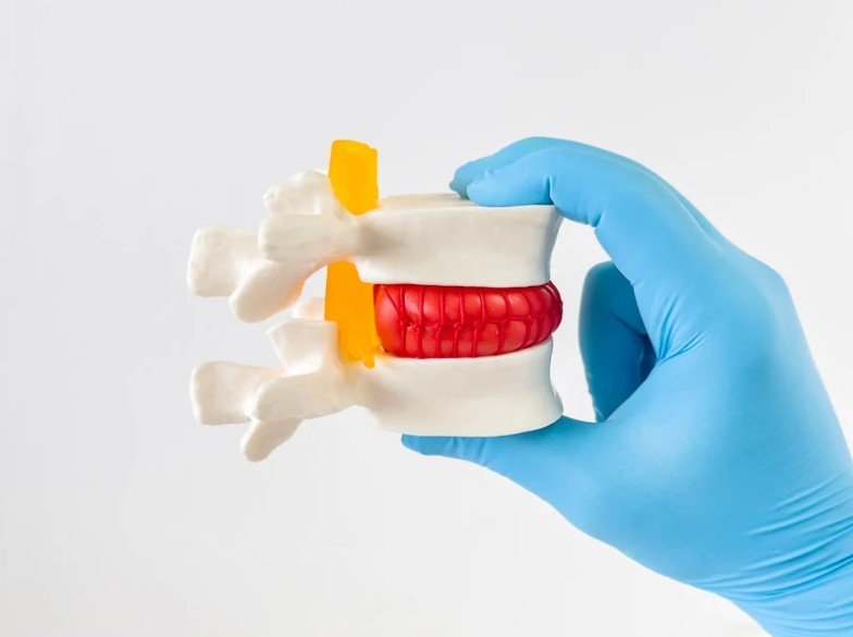 Cirugía de columna para hernia discal en Bogotá - Spine AX