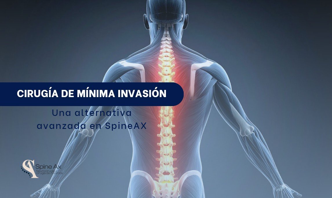 Cirugía de minima invasión-SpineAx