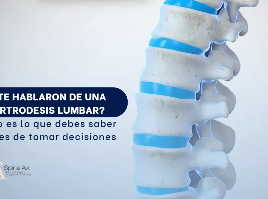 Artrodesis de la región lumbar- SpineAx Bogotá- Escialistas en columna