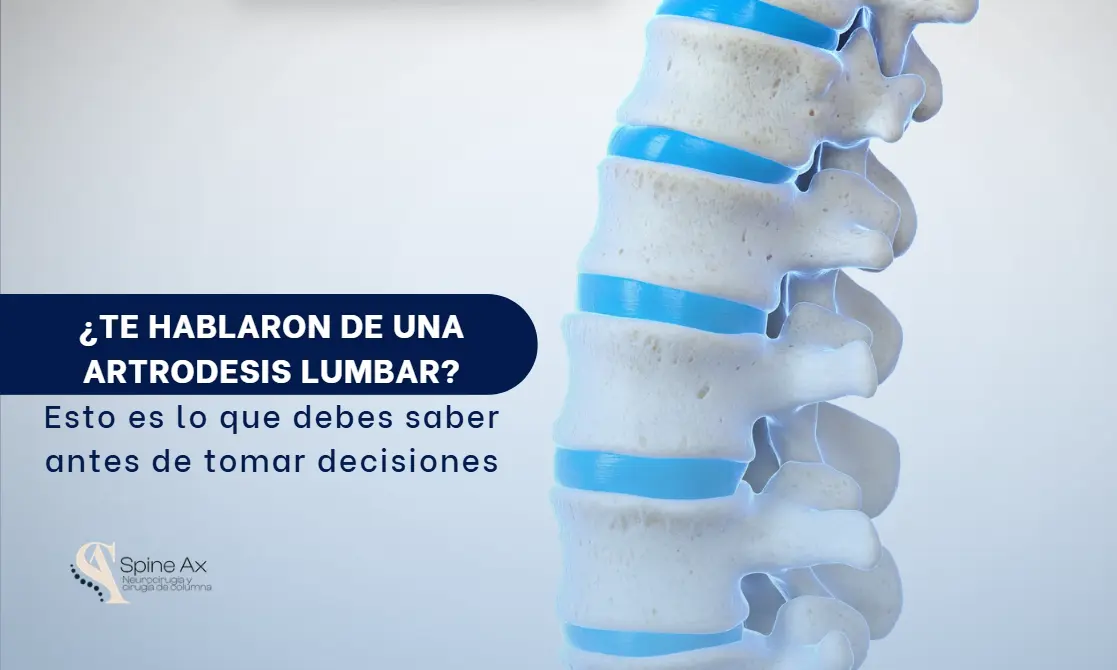 Artrodesis de la región lumbar- SpineAx Bogotá- Escialistas en columna