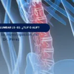 Radiografía de columna lumbar con el segmento L5-S1 resaltado, portada del artículo sobre fusión lumbar TLIF o ALIF del Dr. Pérez en SpineAx