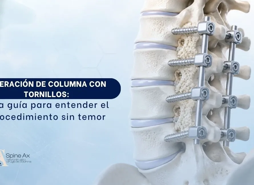 Operación de columna con tornillos una guía para entender el procedimiento sin temor - Spineax
