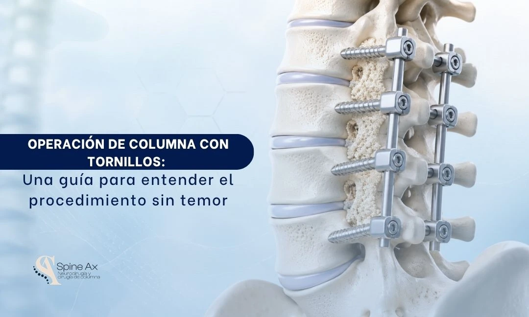 Operación de columna con tornillos una guía para entender el procedimiento sin temor - Spineax