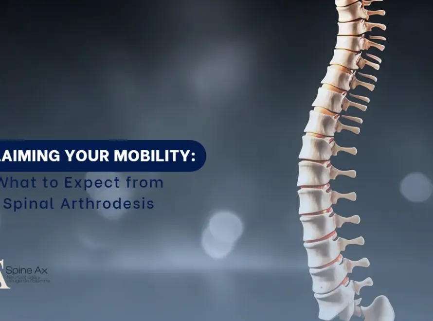 Spineal arthrodesis- SpineAx Bogotá