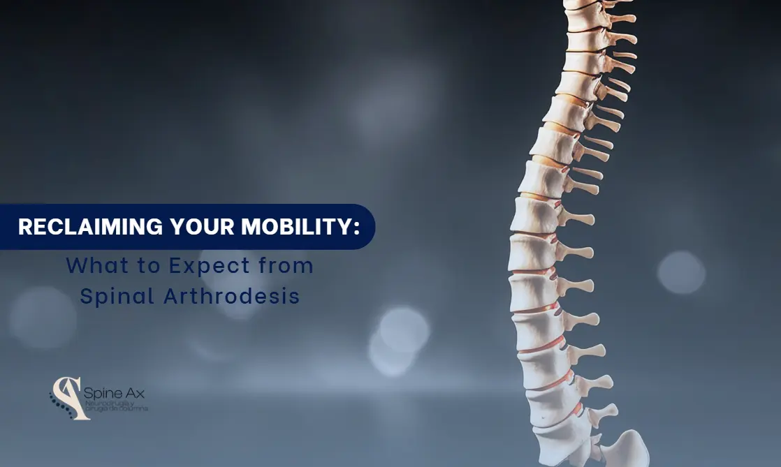 Spineal arthrodesis- SpineAx Bogotá