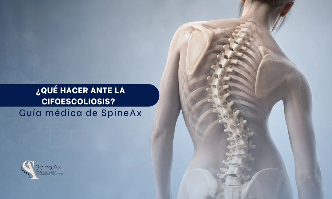 Qué hacer ante la cifoescoliosis Guía médica de SpineAx - Spineax