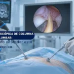 Cirugía endoscópica de columna lumbar Una guía para entender esta técnica - SpineAx