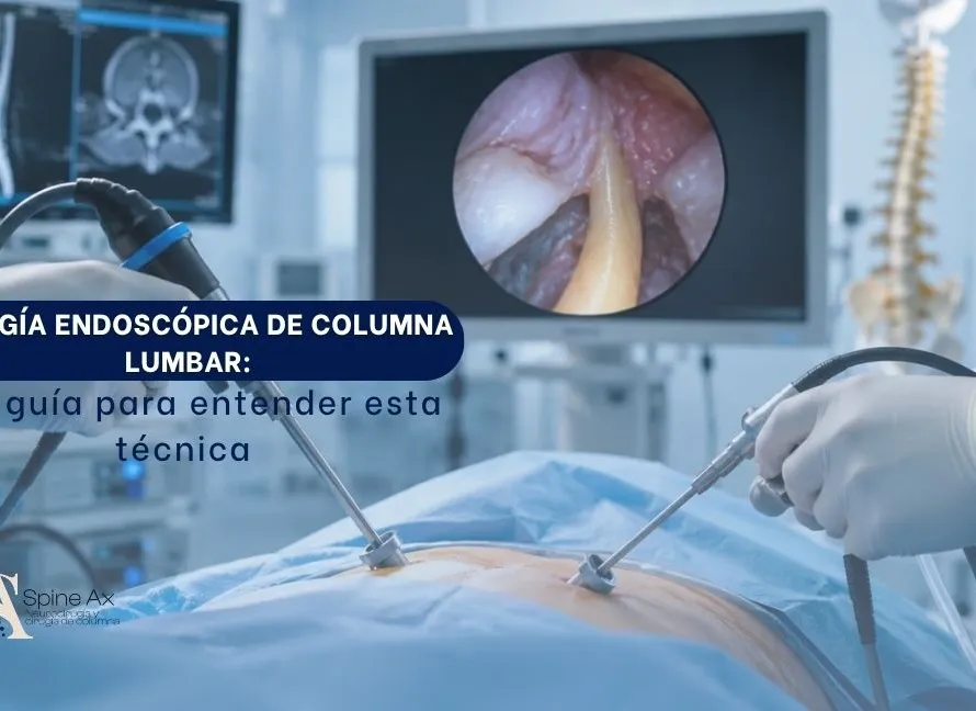 Cirujano realizando cirugía endoscópica biportal de columna con visualización del disco intervertebral y el nervio en el monitor