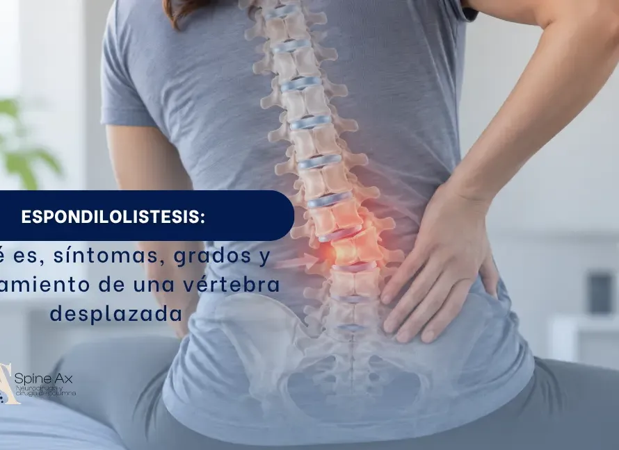 Espondilolistesis qué es, síntomas, grados y tratamiento de una vértebra desplazada - Spineax - Bogotá, Colombia