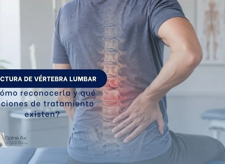 Fractura de vértebra lumbar Cómo reconocerla y qué opciones de tratamiento existen - Spineax