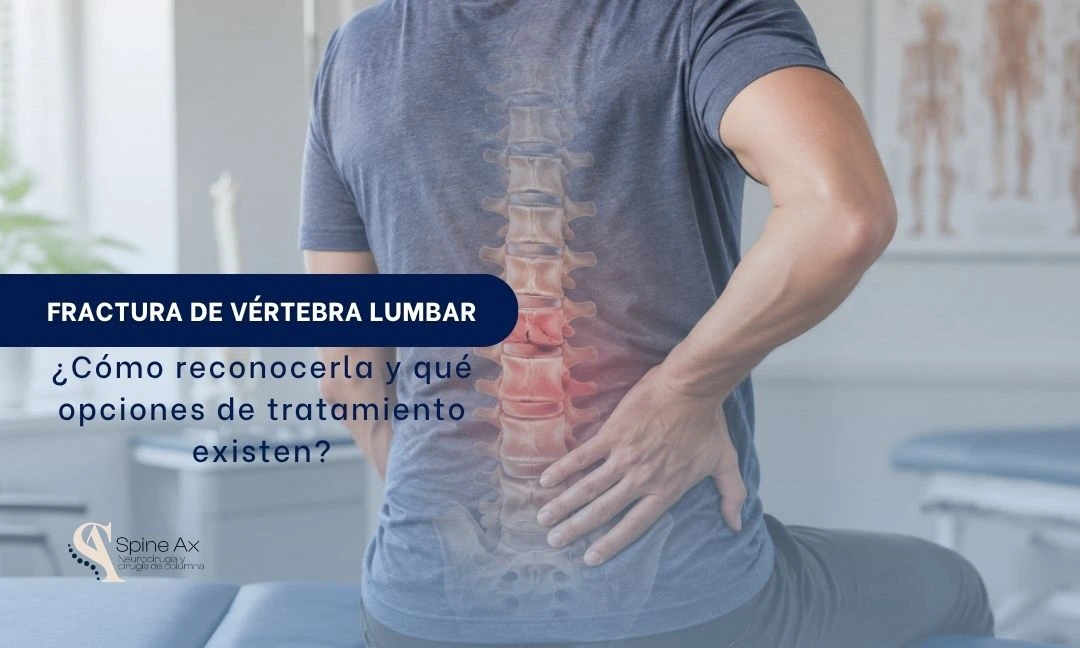 Fractura de vértebra lumbar Cómo reconocerla y qué opciones de tratamiento existen - Spineax