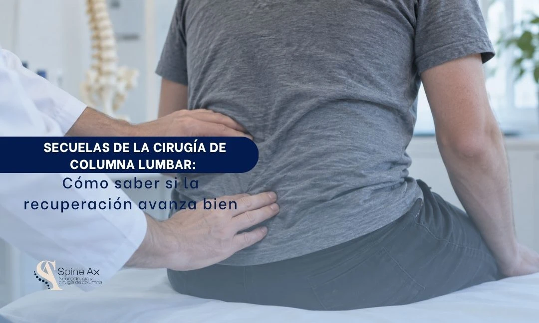 Secuelas de cirugía de columna lumbar Cómo saber si la recuperación avanza bien - Spineax